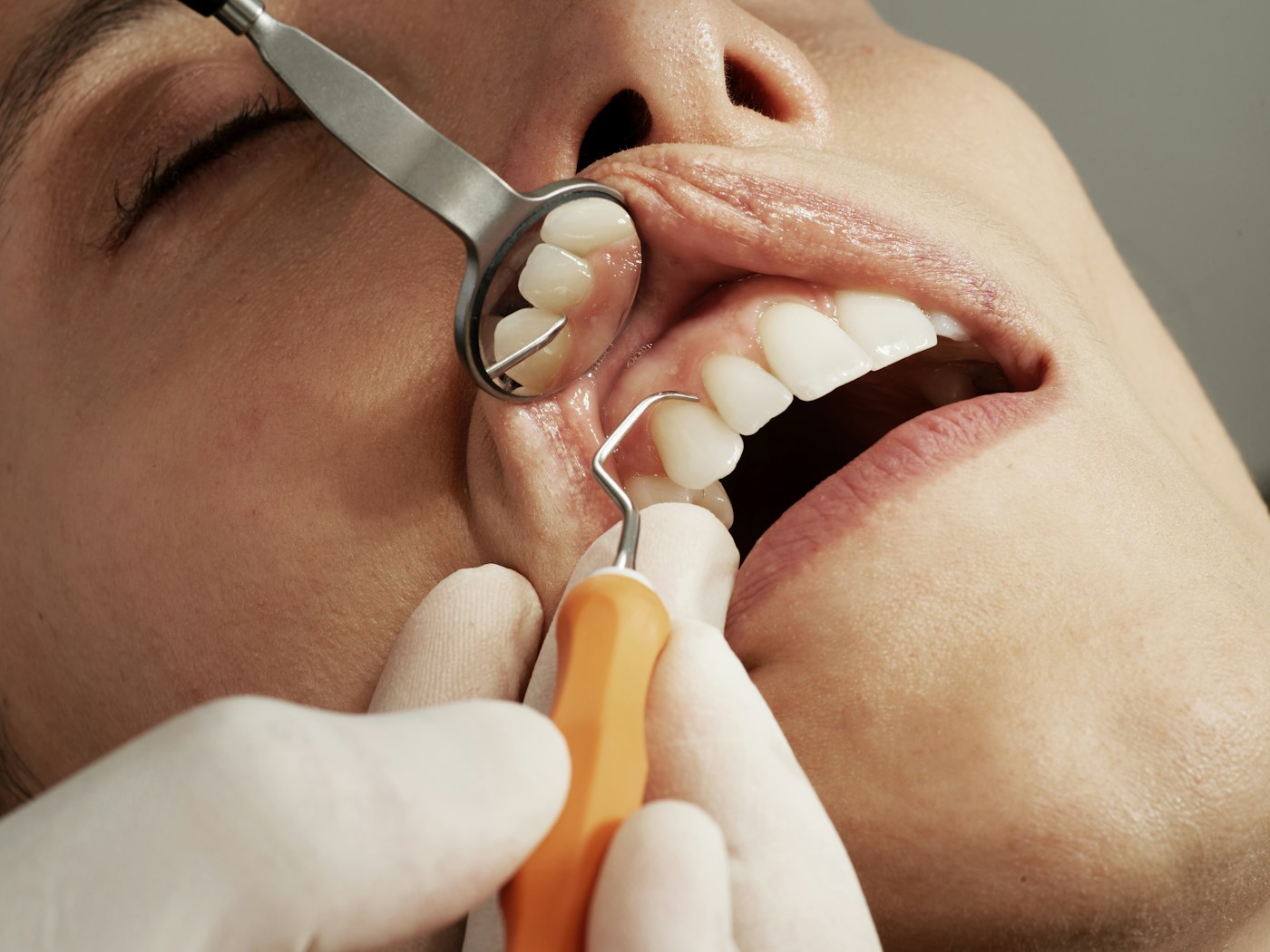 Servicio de Blanqueamiento dental